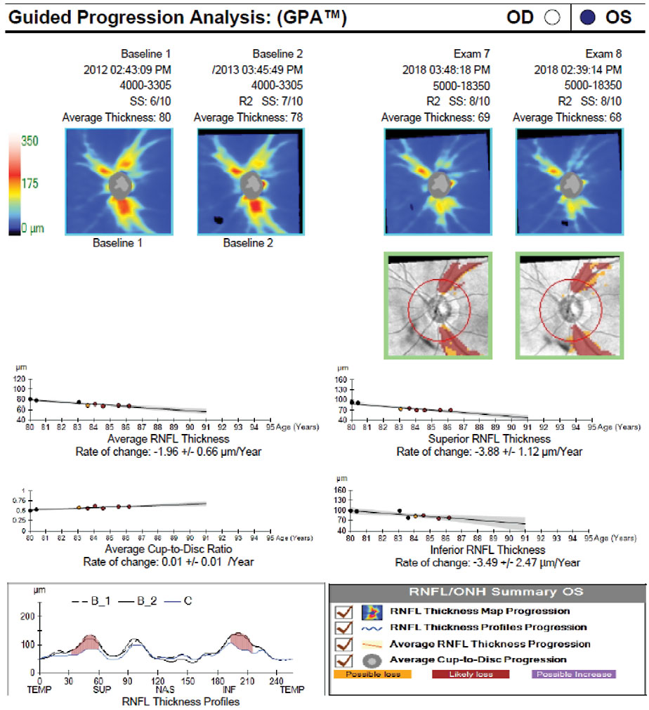Fig. 5. Here, event analysis shows significant change from baseline indicated by yellow and red pixels in the deviation from baseline maps (green boxes) and on the TSNIT profile. There is also visible thinning over time on the thickness maps, as the average RNFL thickness drops from 80µm to 68µm. Trend analysis shows a significant rate of change in average, superior and inferior RNFL as well as an increase in the cup-to-disc ratio.