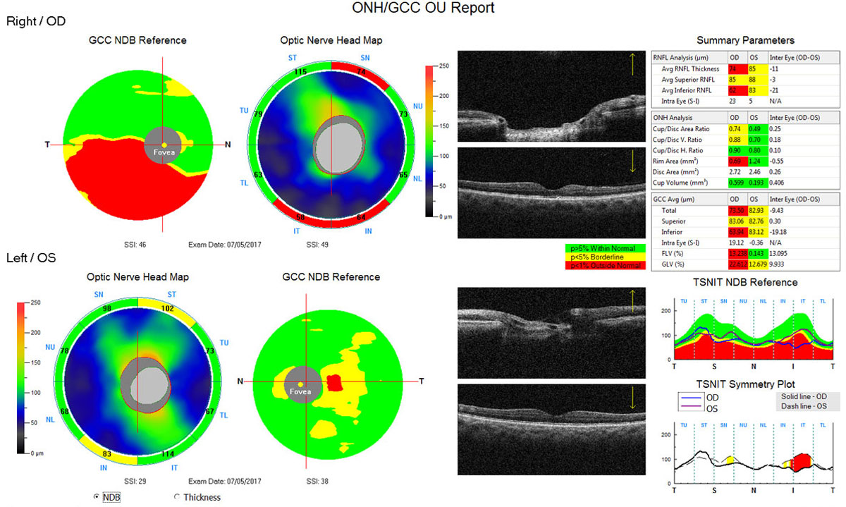 Fig. 1. This Optovue OCT scan shows thinning of the inferior RNFL (absence of “warmer” greens/yellows, and more “cool” blue inferior to the disc) and the inferior ganglion cell complex (presence of red areas below the horizontal) in the right eye. On the lower right portion of the printout, the RNFL is plotted against the normative/reference database, where the inferior RNFL of the right eye dips well into the abnormal “red” range. Below that, the symmetry plot color-codes areas of significant asymmetry between the right and left eye.