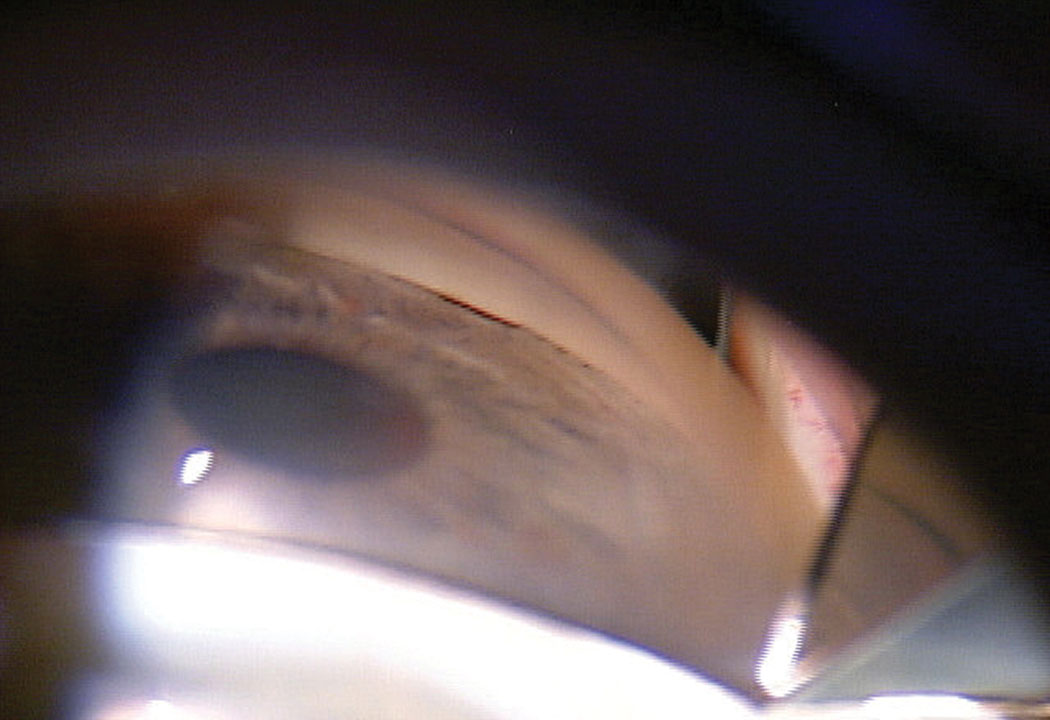 Fig 1. This patient’s initial gonioscopy shows a narrow angle with the TM barely visible.