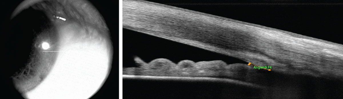 Fig 2. The patient’s initial OCT shows a narrow angle.