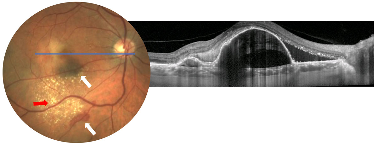 Fig. 2. Possible CNV findings such as subretinal hemorrhage (white arrows), exudates (red arrow) or macular thickening (not readily visible in photo, OCT shows macular thickening from large PEDs) should raise a red flag for further testing. 