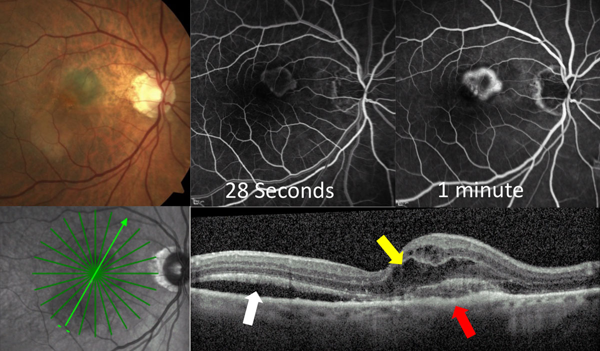 Fig. 3a. This classic CNV shows early hyper-fluorescence at 28 seconds on IVFA with localized area of leakage at one minute. OCT shows the lesion primarily on top of the RPE (red arrow) with overlying intraretinal fluid (yellow arrow) and adjacent subretinal fluid (white arrow). 