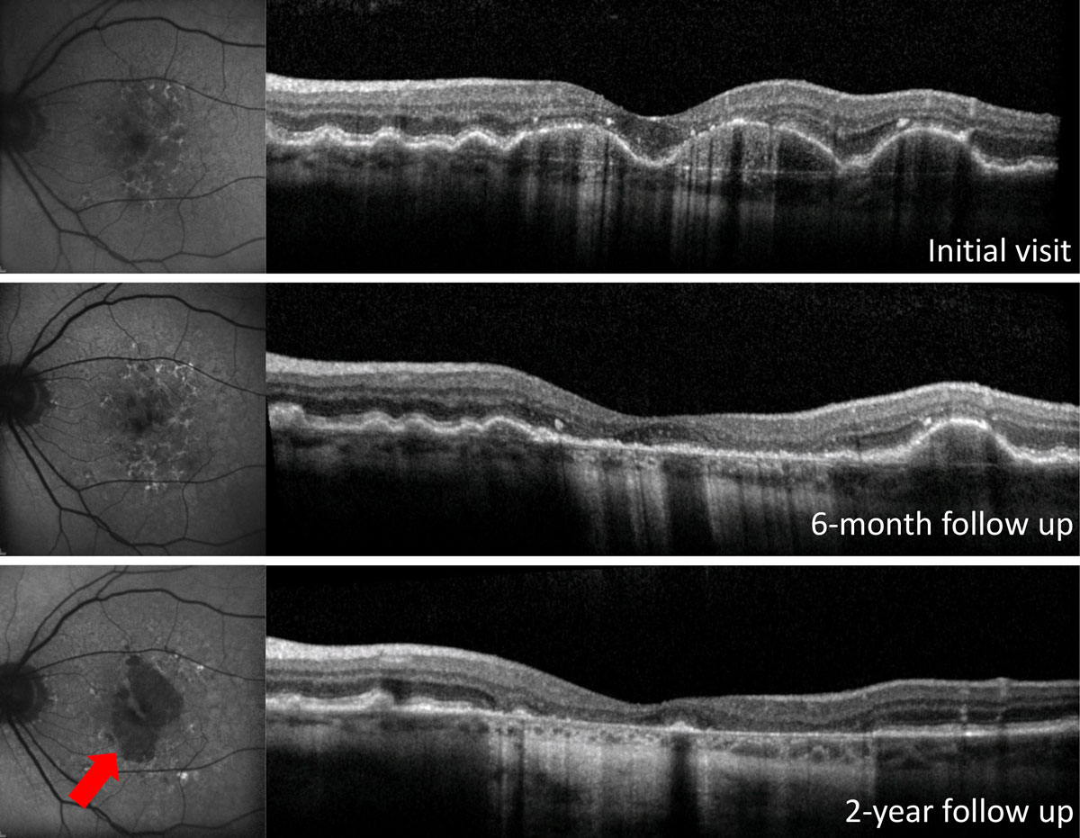 Fig. 4. On FAF, at left, GA shows as prominent hypo-autofluorescence (red arrow). On OCT, at right, GA results in atrophy of the outer retinal layers, including loss of the photoreceptor integrity line and ONL. In addition, there is increased light penetrance into the choroid due to atrophy of the highly reflective RPE layer. 