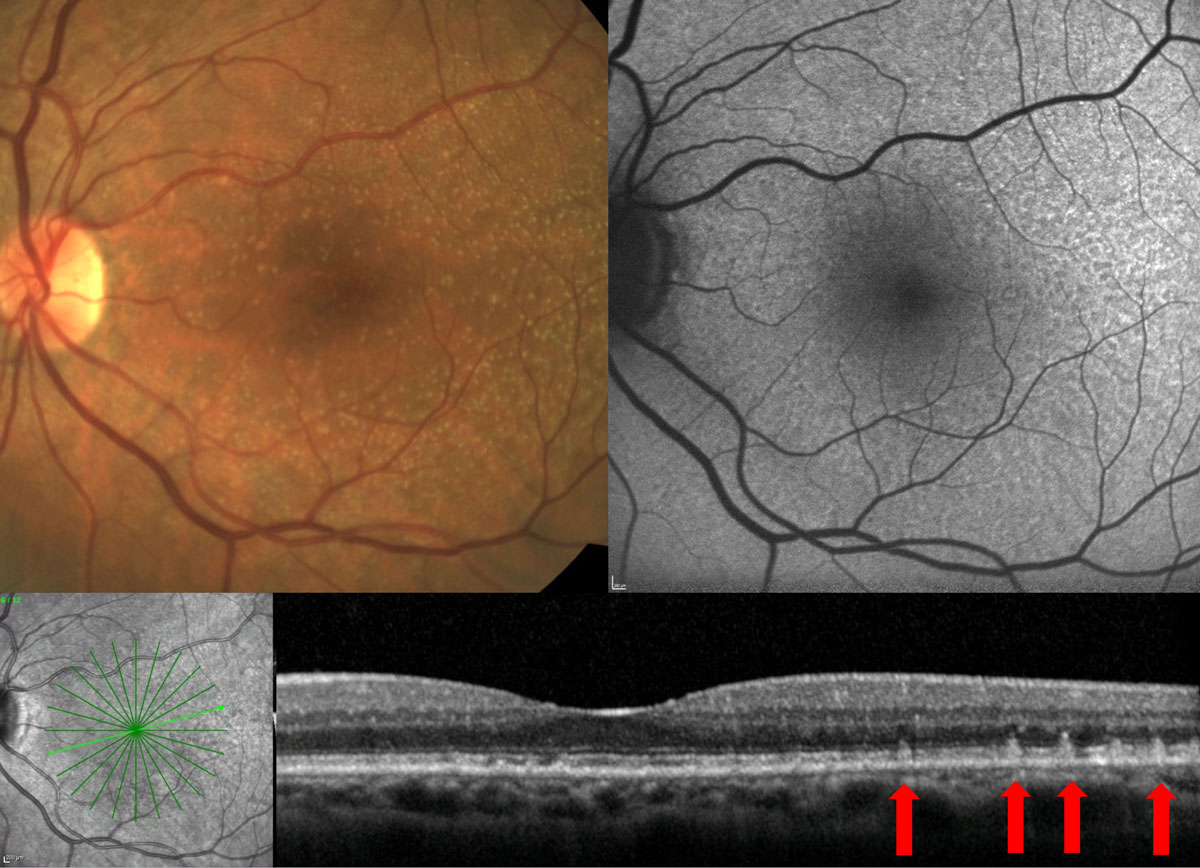 Fig. 5. Fundus examination shows small- to intermediate-sized drusen; however, FAF and OCT show presence of RPD. 