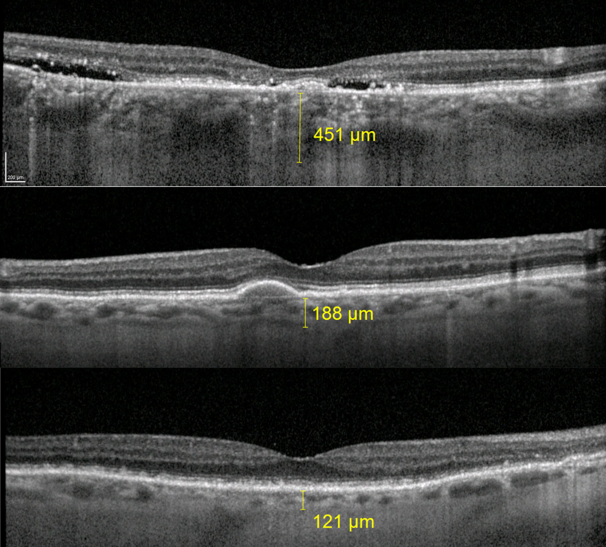 Fig. 6. The top image is a patient with chronic central serous retinopathy and subfoveal choroidal thickness measuring 451µm. The middle image is a patient with large drusen from AMD and subfoveal choroidal thickness of 188µm. The bottom image is a patient with RPD and subfoveal choroidal thickness of 121µm. 