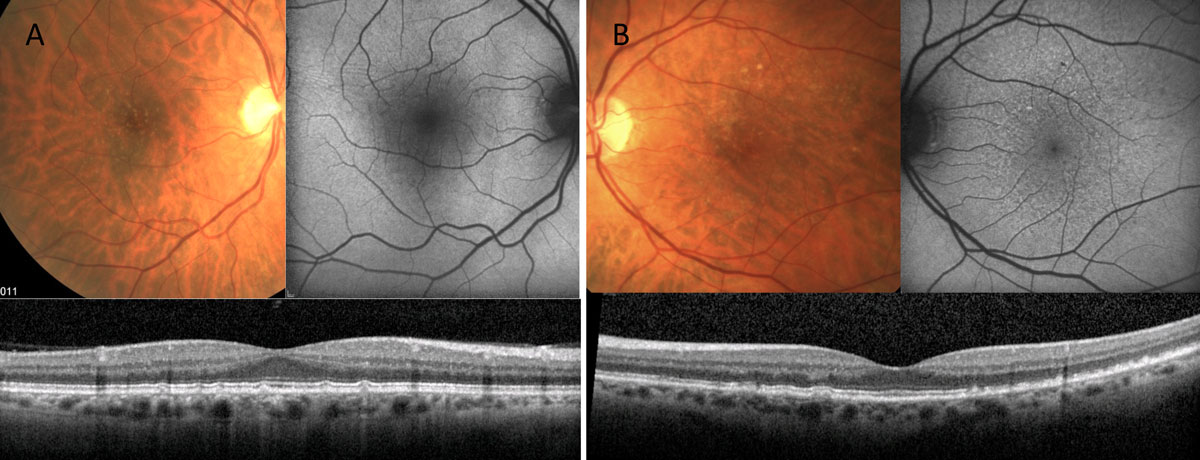 Fig. 7. Both of these patients have small- to intermediate-sized retinal drusen. Patient A’s FAF shows fairly normal autofluorescent signal, while patient B has alteration to the FAF greater than the extent of disease seen clinically. 