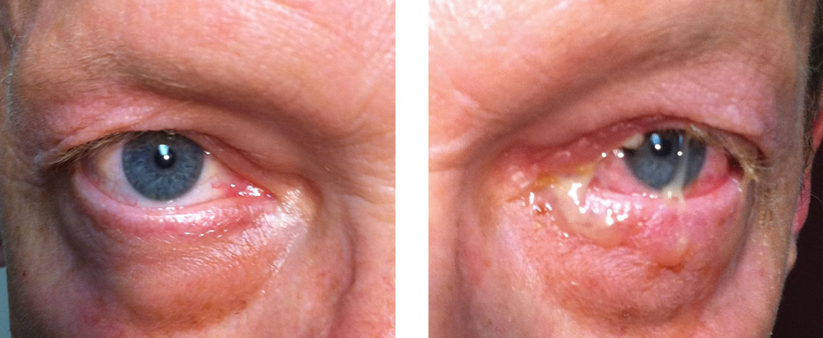 This patient’s examination reveals acute bacterial conjunctivitis. Despite the severity of this infection, the location is limited to the conjunctiva, so using a topical antibiotic is an acceptable treatment choice. Appropriate topical choices include Polytrim, a fluoroquinolone (ciprofloxacin, ofloxacin) or tobramycin.1-4