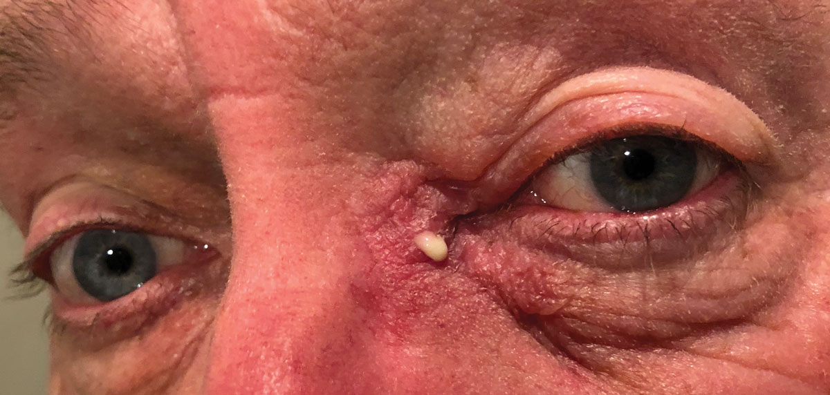 This patient has a periorbital skin infection with bacterial purulence. Since the infection involves the skin/skin structures surrounding the eye, an oral antibiotic agent would increase treatment success. Appropriate systemic agents include Augmentin, Keflex, azithromycin or Bactrim. When these agents are contraindicated due to an allergy, a fluoroquinolone (levofloxacin, moxifloxacin) may be considered. If there is concern regarding the potential for MRSA, systemic options include Bactrim, doxycycline or clindamycin.1-4,32-34,42