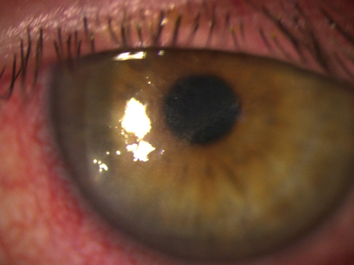 HSV stromal keratitis is considered an immune-mediated response resulting in inflammation of the ocular tissue. It is characterized by inflammation of the stromal bed. 
