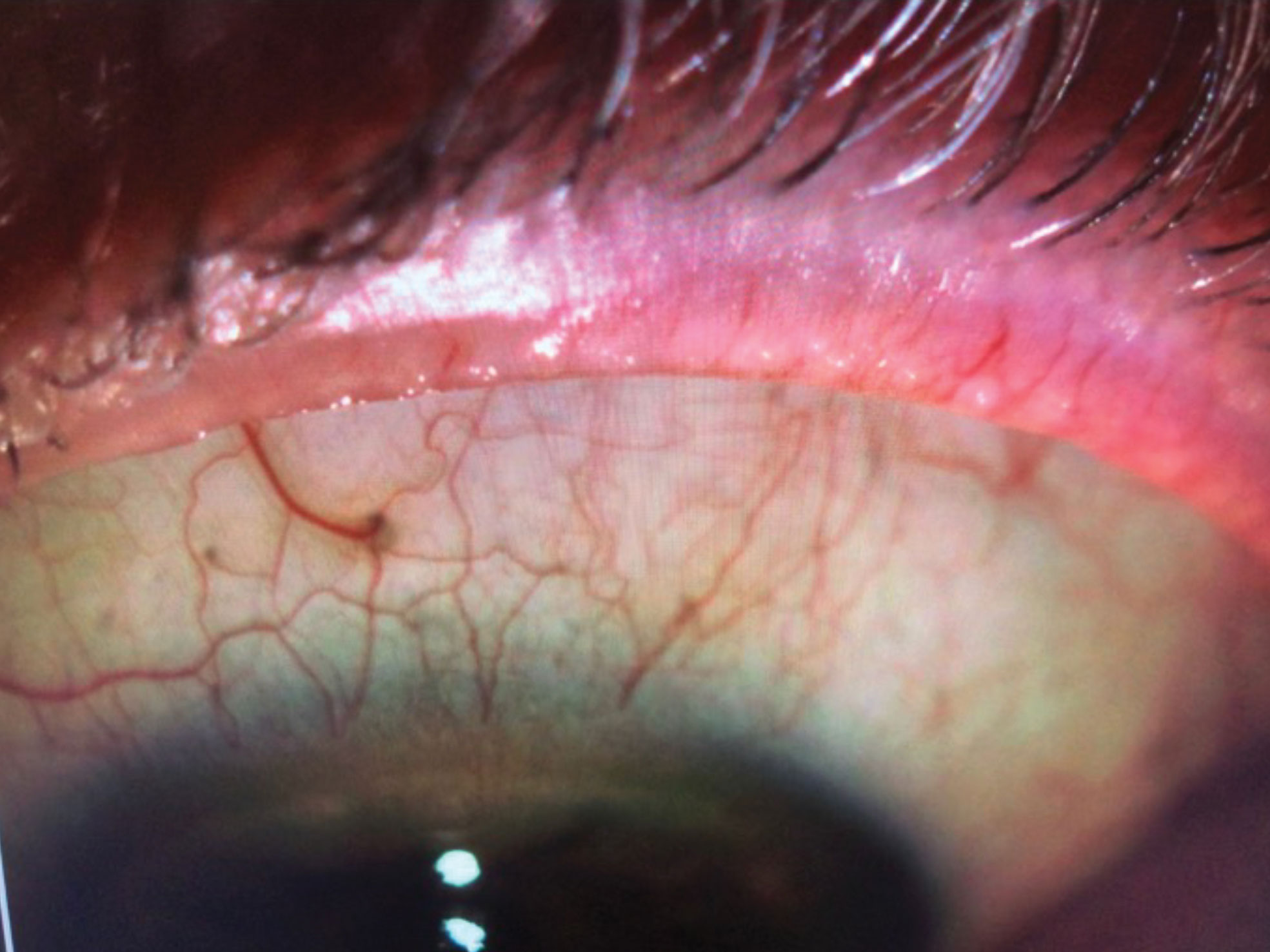 IPL can help remove telangiectasia in the eyelid margins of MGD patients.