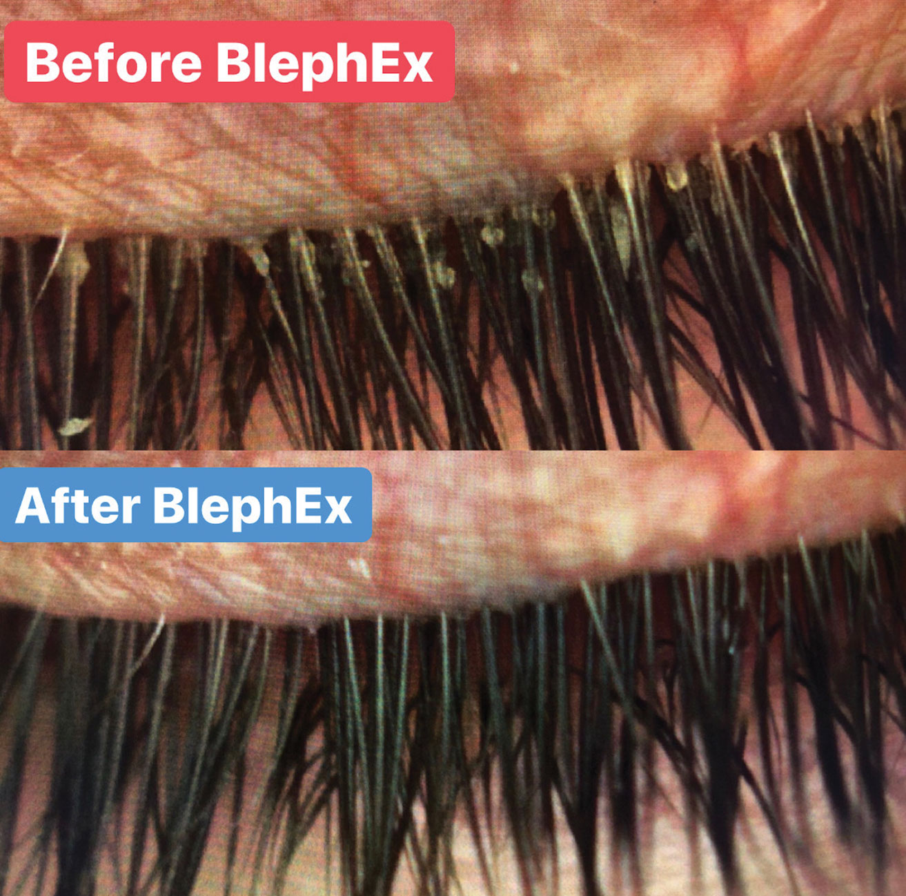 Advances in the management of MGD include a number of office-based therapeutics, such as BlephEx. Lid debridement helps remove biofilm and debris and uncap the openings of the oil glands.