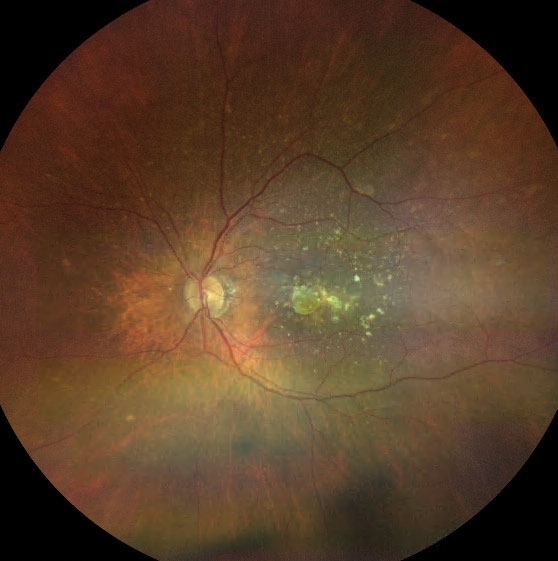 Fig. 2. Late AMD with large confluent drusen and a small area of central geographic atrophy.