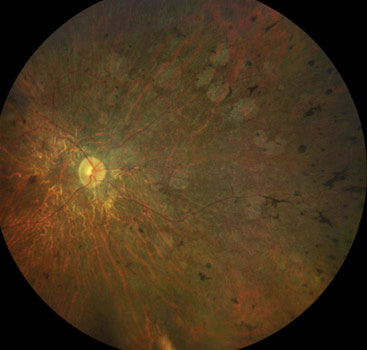 Fig. 3. A late-stage retinitis pigmentosa patient with severe retinal atrophy, bone spicules and attenuated vessels.