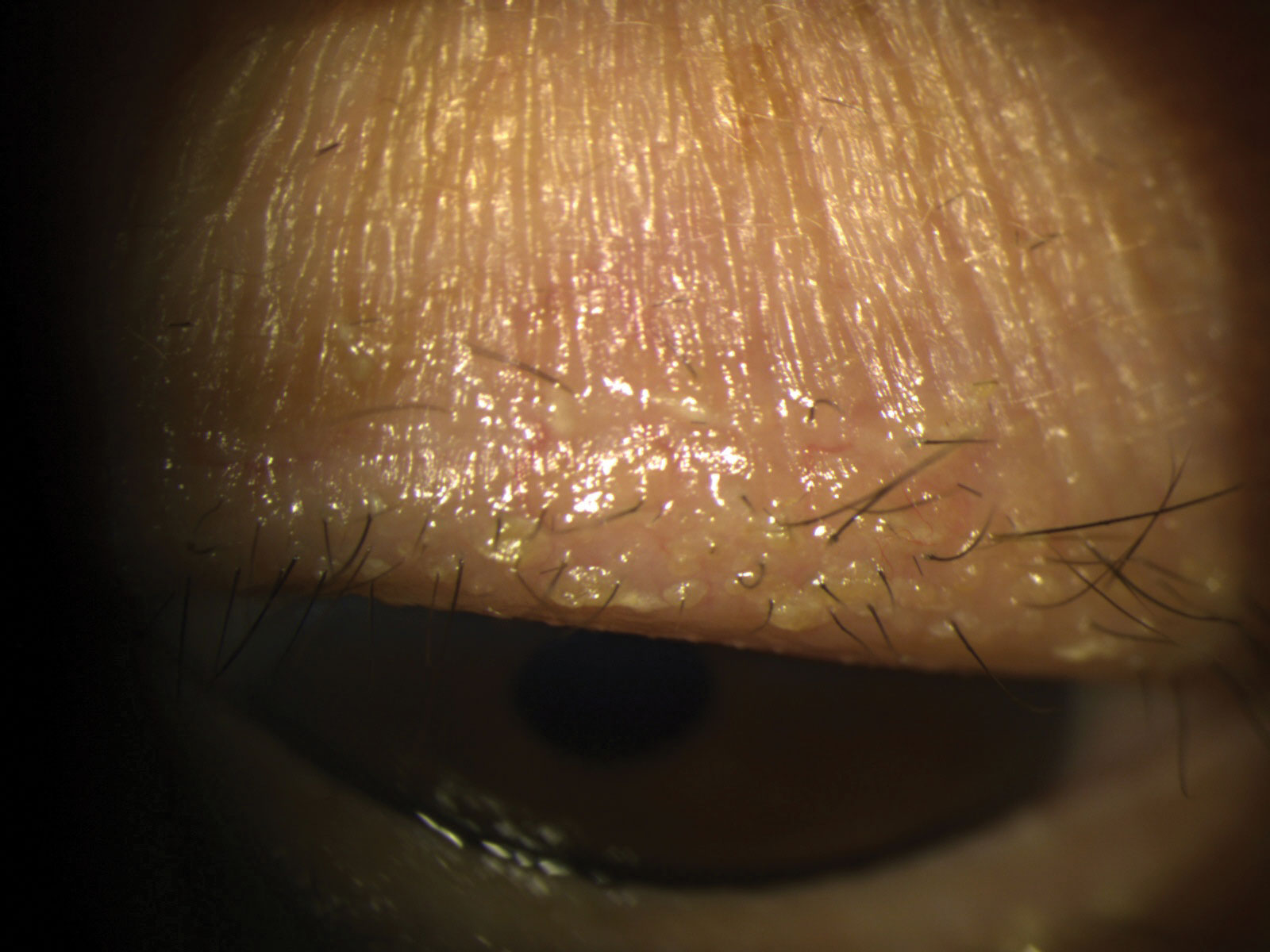 Stubborn debris and scurf along the base of lashes. The patient was started on a regimen of warm compresses and 0.01% hypochlorous acid lid cleaning routine BID OU.