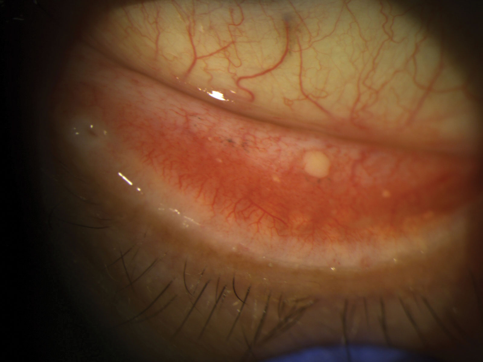 Chronic ocular allergies can sometimes result in conjunctival concretions. This patient had complaints of persistent foreign body sensation, which resolved once the concretion was excised.