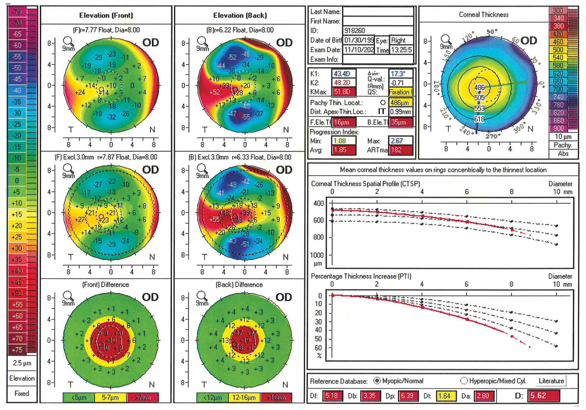Fig. 2. Pentacam Belin-Ambrosio Enhanced Ectasia Display showing early keratoconus. Note how the corneal percentage thickness increase (lower right graph) is outside normal limits. Also, the color-coded “front” and “back” differences, comparing this patient to a best-fit sphere, are a cause for concern.