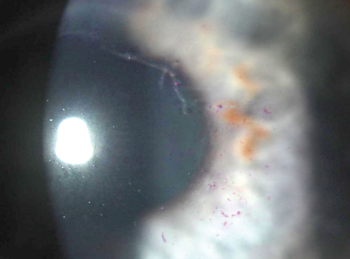 Pseudodendrite seen with HZO. This occurred two weeks after the beginning of a shingles rash involving the brow of this patient. Note that the lesion is not ulcerated and only stains with rose bengal in a patchy manner.