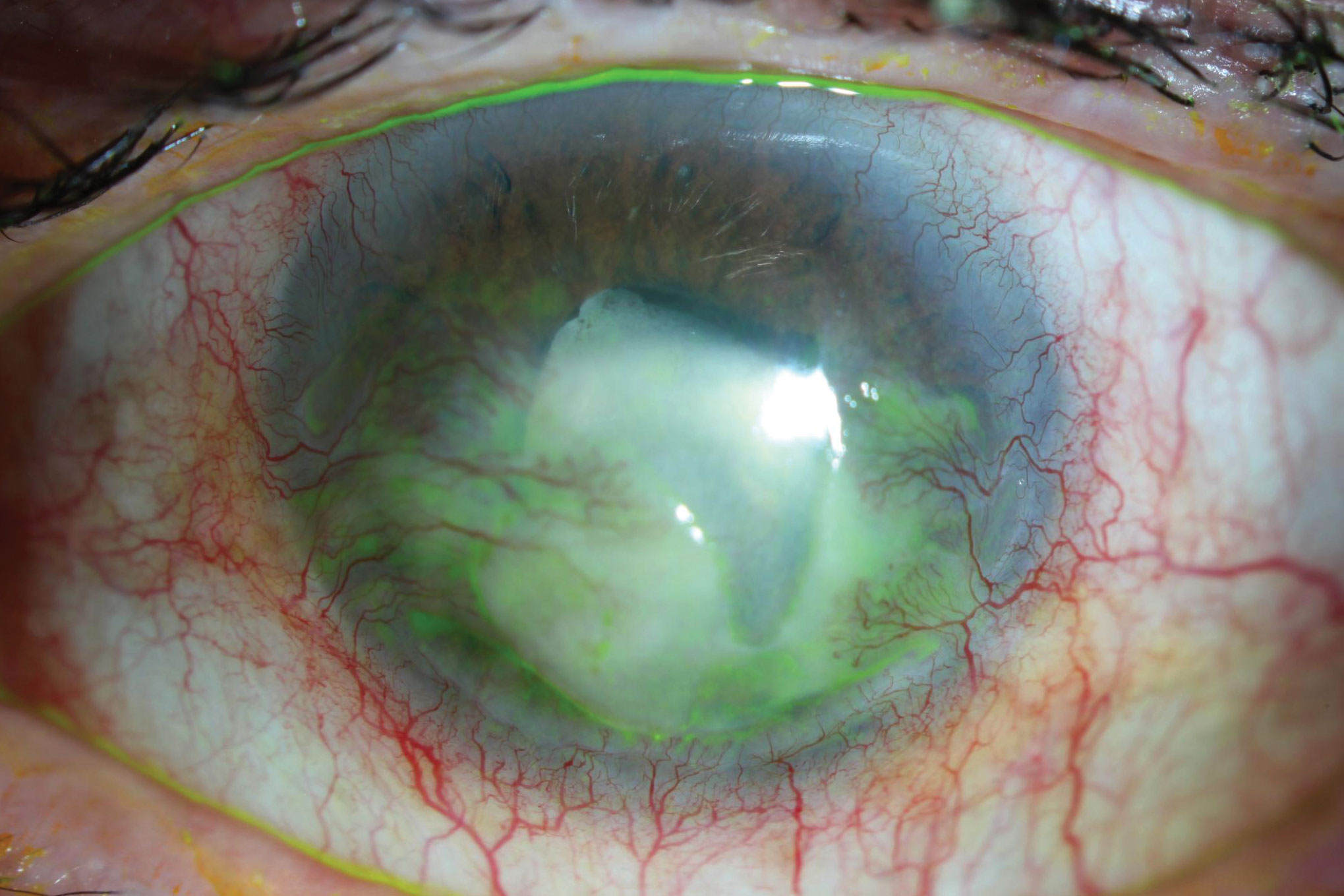 This is the patient from Figure 1. After years of dealing with unremitting zoster-related inflammation, iritis and neurotrophy, the patient’s cornea opacified and vascularized, and the pupil became irregular and non-responsive. His case illustrates the potentially catastrophic impact of HZO on the visual system.