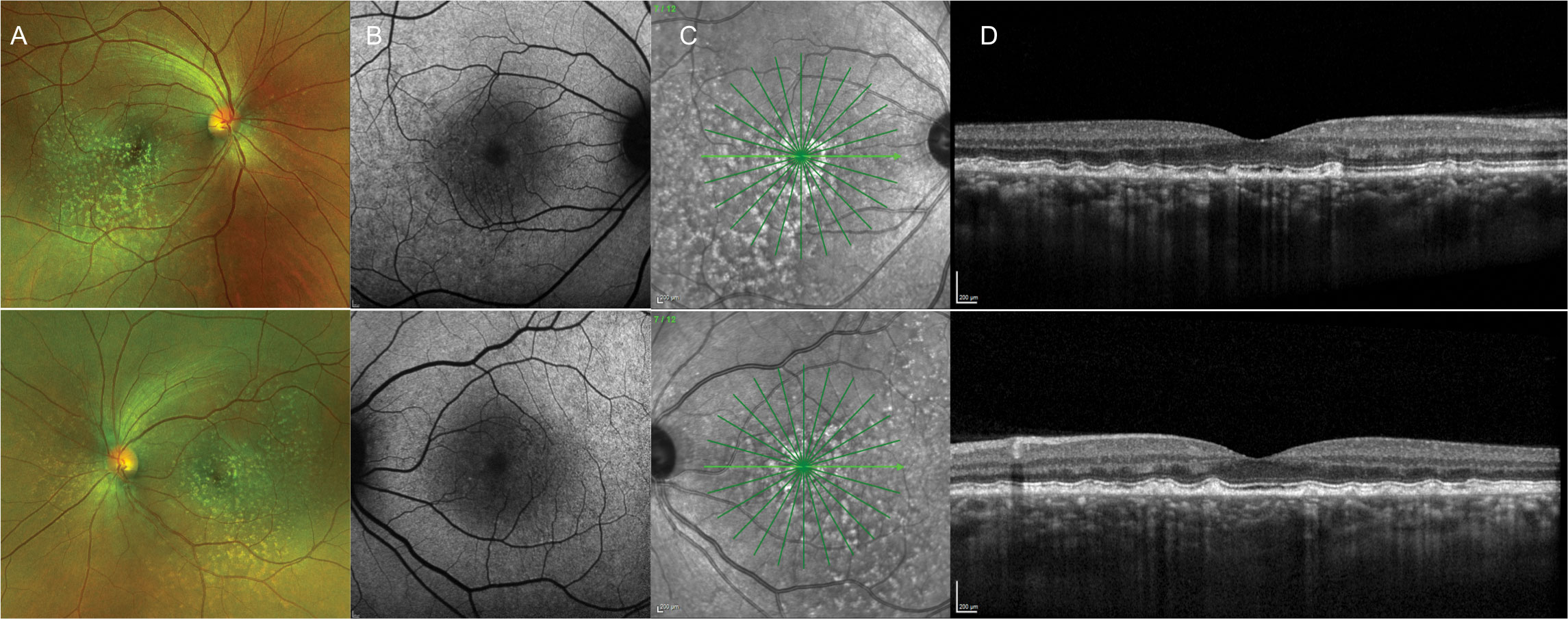 A 42-year-old Black male presented with a phenotypic appearance of autosomal dominant drusen. He had no family history and presented asymptomatically with 20/20 vision OD and OS. Images: (A) widefield photo, (B) FAF, (C) infrared reflectance and (D) OCT.