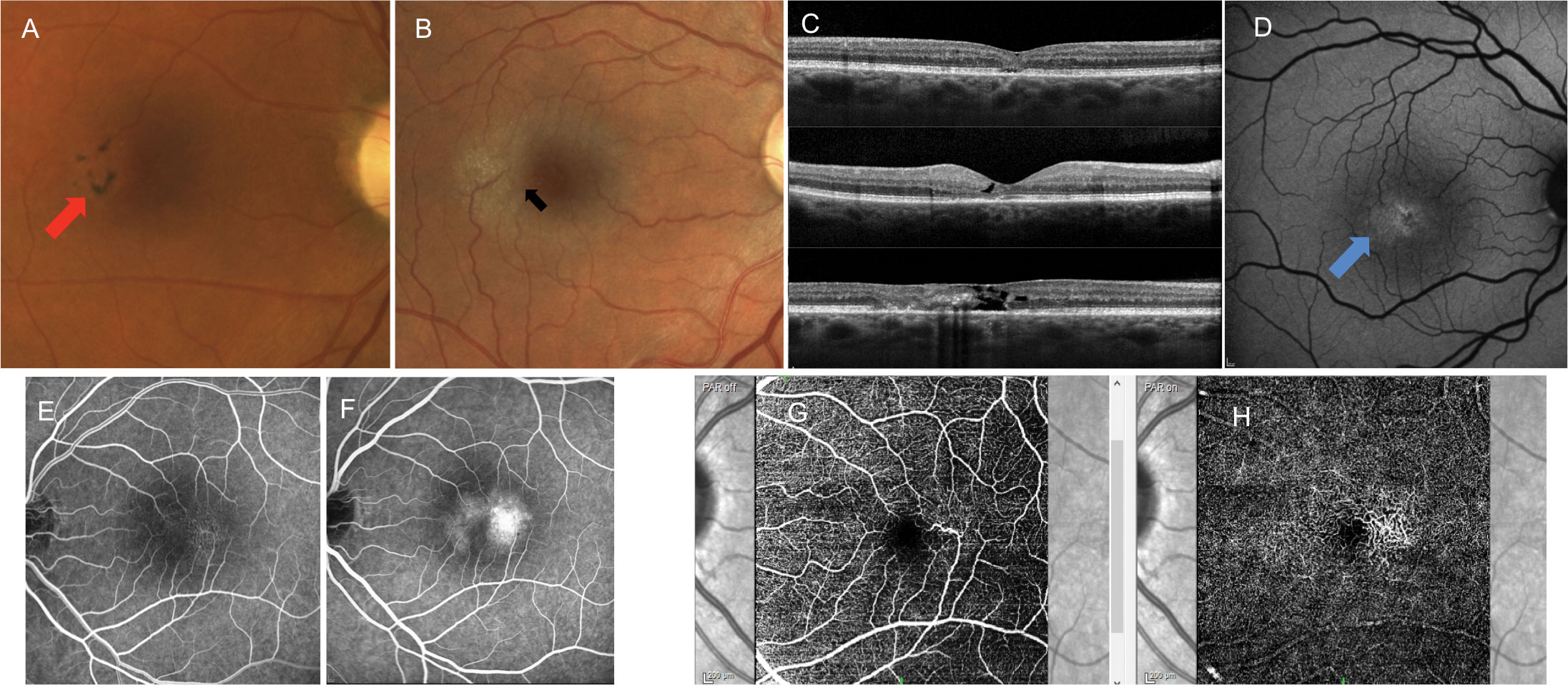 Patients with MT2 may present with the following findings: (A) pigmentary plaques (red arrow), (B) juxtafoveal whitening concentrated temporally, crystalline deposits and right angle vessels (black arrow), (C) variable retinal and photoreceptor atrophy and classic appearance of internal limiting membrane drape on OCT, (D) altered autofluorescent patterns typically showing first as hyper-autofluorescence temporally (blue arrow), (E) juxtafoveal telangiectatic vessels concentrated temporally on intravenous FA that leak in late stages and (F) telangiectatic vessels concentrated temporally in both the superficial (G) and deep (H) vascular plexus on OCT-A. These images are all examples of different patients.