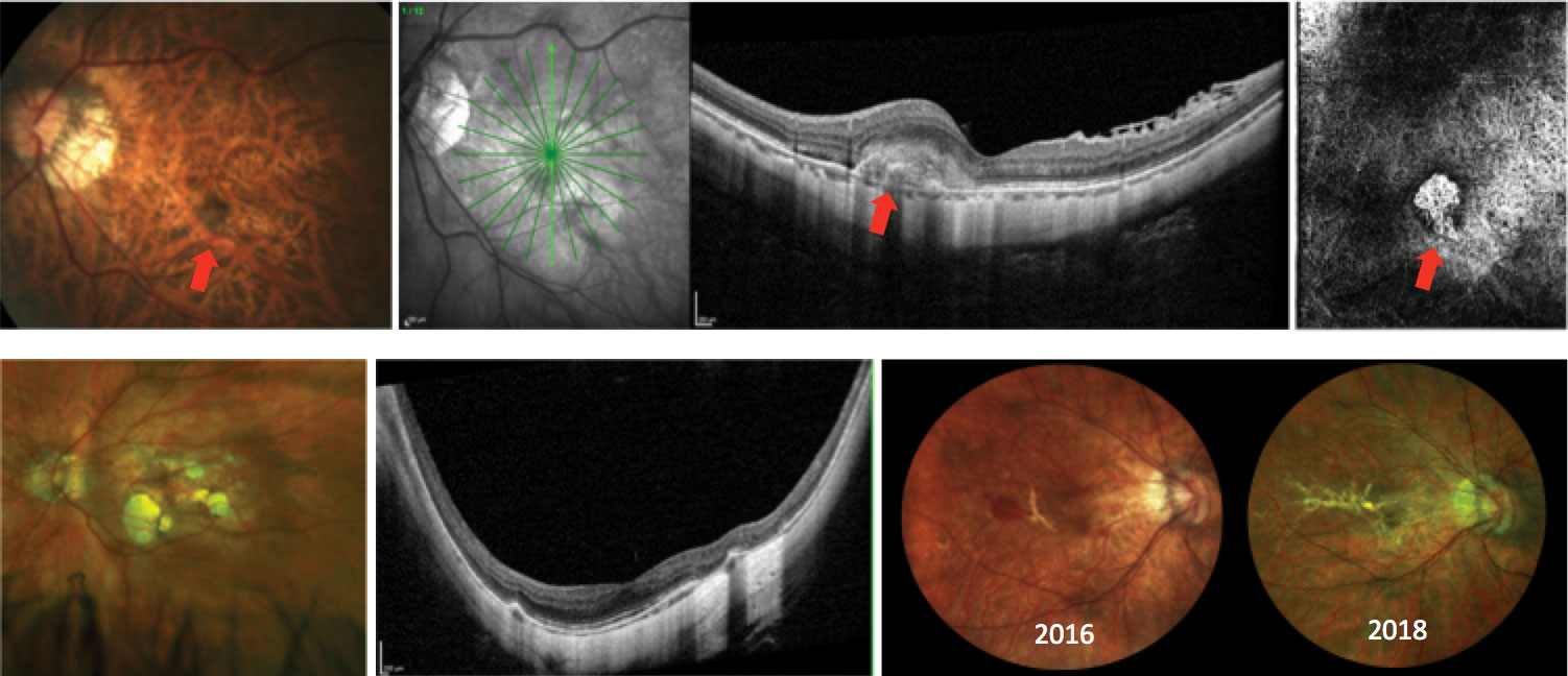 Various presentations of myopic degeneration. The top images show myopic CNV (red arrows) on fundus photo, OCT and in the avascular complex of the OCT-A. Bottom left shows a patient with posterior staphyloma and myopic macular atrophy. The bottom right shows progressive lacquer crack formation. In 2016, the patient had subretinal hemorrhage not associated with CNV.