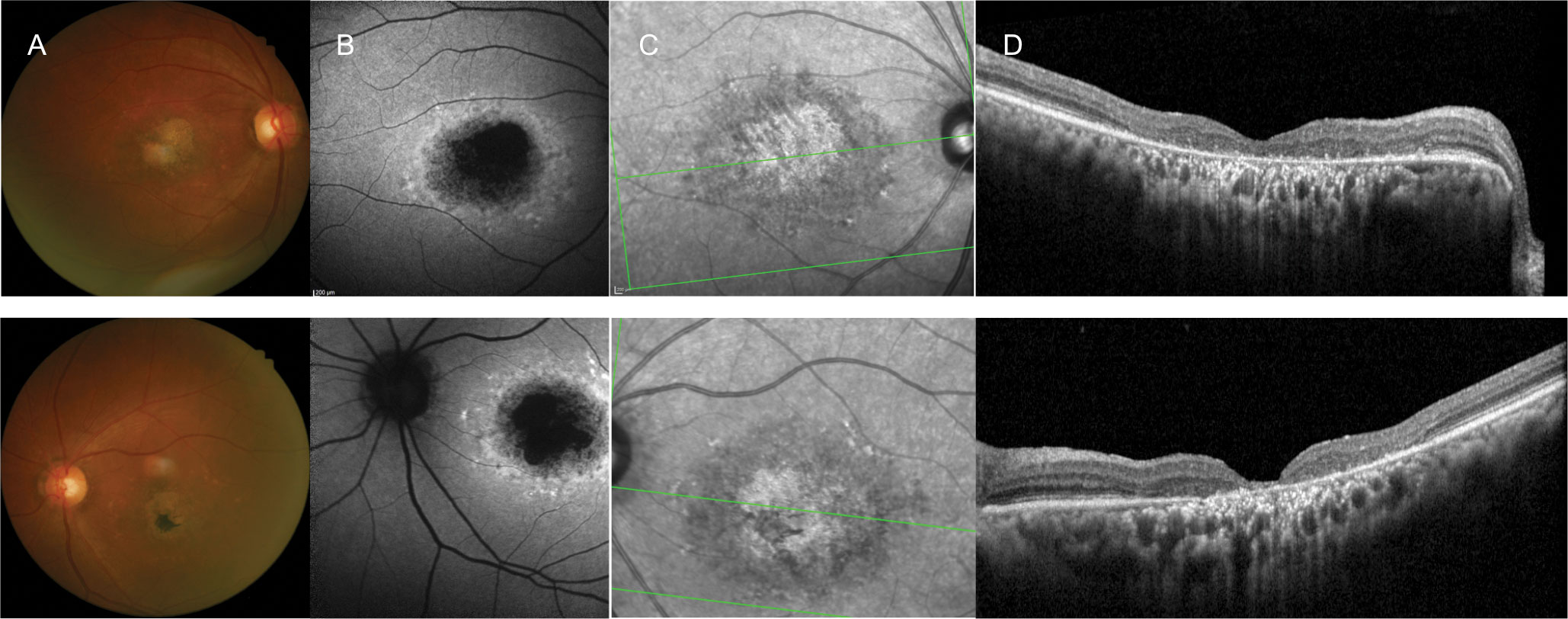 A 60-year-old white female with longstanding vision loss since her late teens and 20/150 best-corrected vision OD and OS. She presented with: (A) macular atrophy and surrounding yellow fleck lesions, (B) a bull’s eye-type pattern, (C) infrared reflectance OU on FAF and (D) outer retinal atrophy on OCT OU. One of her three siblings (a brother) had the same ocular condition. The others had normal vision, and there were no other affected family members, including her parents. The patient’s history was consistent with an autosomal recessively inherited condition, and she was clinically diagnosed with Stargardt’s disease. Genetic testing was offered, but she declined.