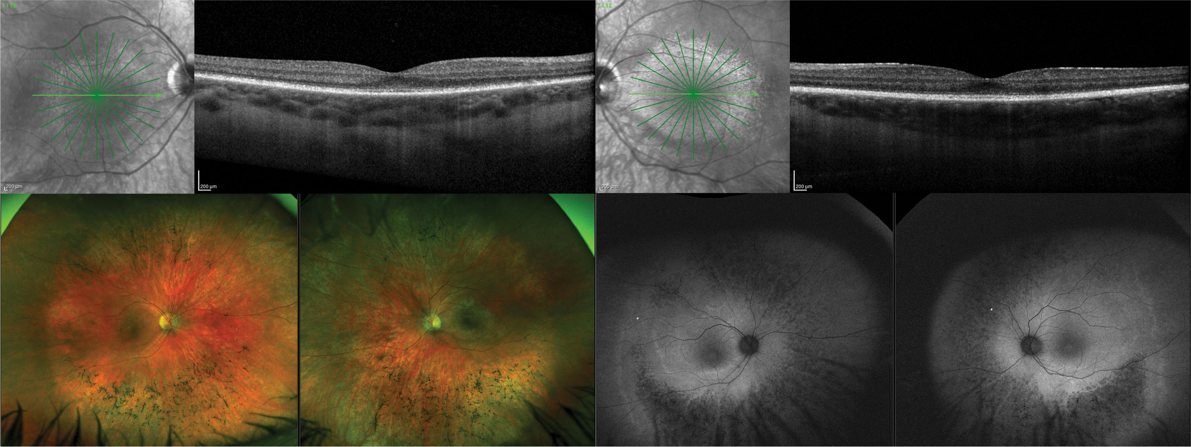 A 22-year-old white male presented with a homozygous pathogenic variant identified in TTLL5, consistent with cone rod dystrophy. OCT images show diffuse disruption of the photoreceptor integrity line. The macula has mild pigmentary alterations while the peripheral retina has a bone spicule-type appearance. FAF shows hypo-autofluorescence in the peripheral retina with hyper-autofluorescence centrally indicating both central (cone) and peripheral (rod) dysfunction.