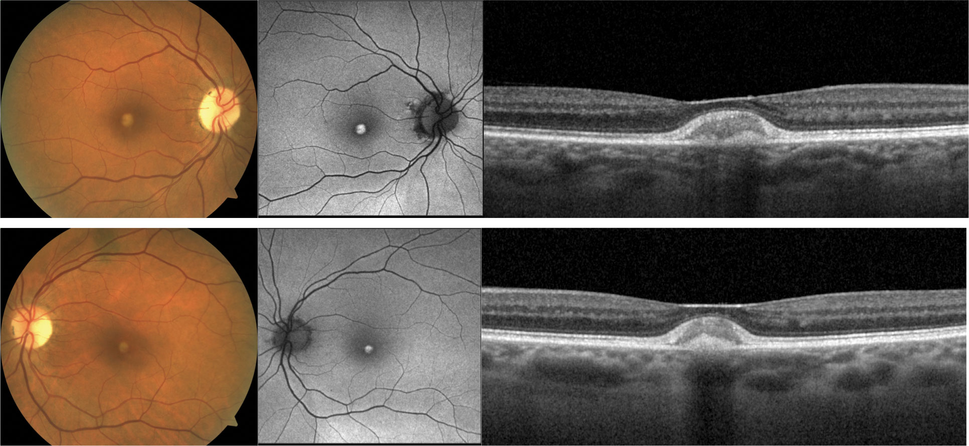 A 69-year-old white female with AOVD has bilateral, circular, yellow, central vitelliform lesions (left). These lesions are hyper-autofluorescent on FAF (middle) and present on OCT as reflective subretinal deposits between the RPE and the photoreceptors (right). The patient presented with good visual acuity of 20/30 OD and OS.