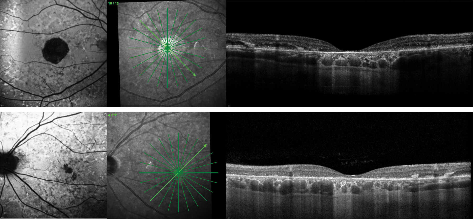 A 54-year-old white male presented with BCVA 20/70 OD and 20/50 OS. He complained of gradually worsening vision over the last two to three years. He had no family history of blindness. Fundus exam revealed bilateral yellow, fleck-type lesions scatted in the posterior pole and macular atrophy. FAF showed diffuse alteration of the autofluorescent signal. OCT showed hyper-reflective outer retinal deposits OU, photoreceptor atrophy OS and more extensive macular atrophy OD. The appearance is similar to Stargardt’s disease, but genetic testing identified a heterozygous pathogenic variant in PRPH2 more consistent with multifocal pattern dystrophy mimicking Stargardt’s.