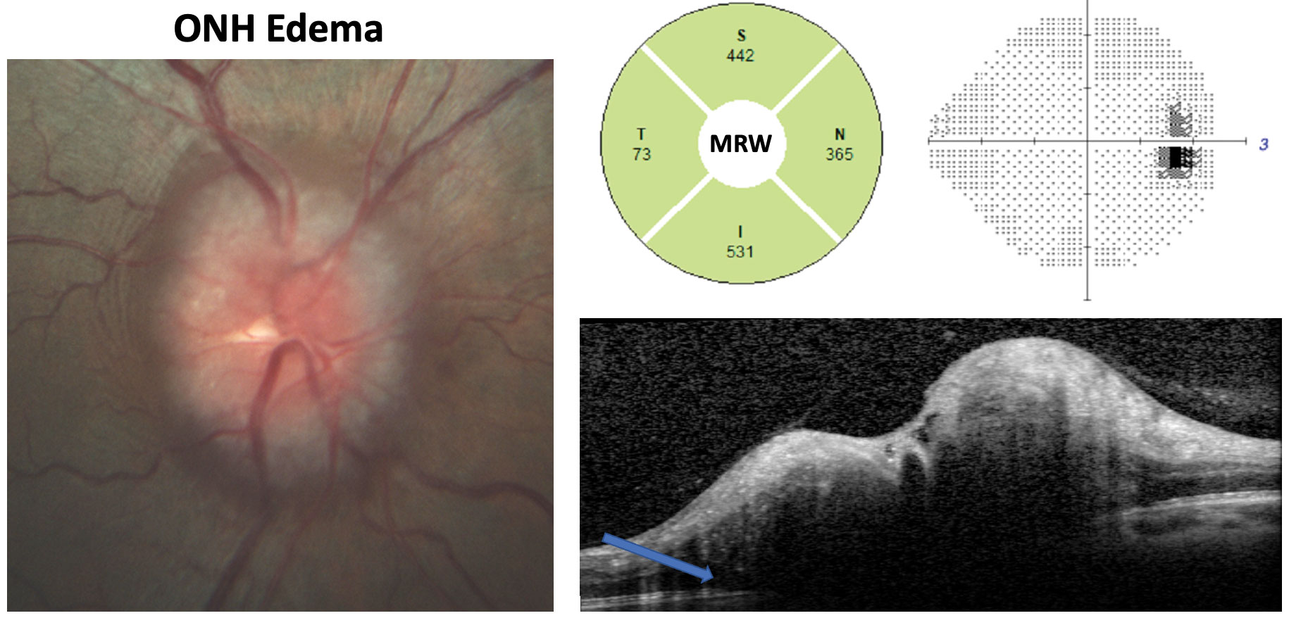 This IIH patient has an opening ICP of 42cm H2O. Fundus photography shows Frisen grade 3 edema. Note the substantially increased MRW, enlarged blind spot on the grayscale plot and the OCT cross-section showing subretinal hyporeflective space (blue arrow) consistent with ONH edema.