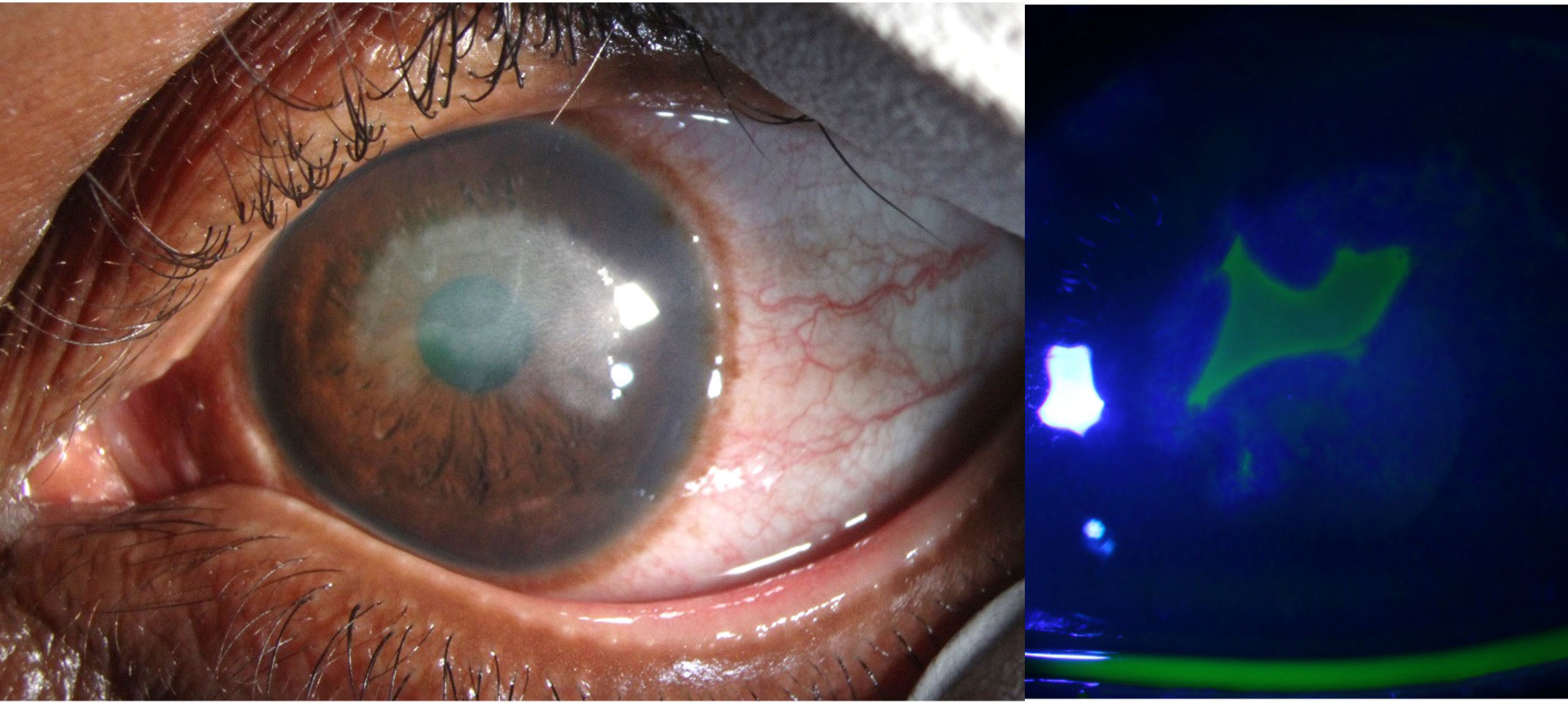 This patient presented with blurred vision but did not complain of significant pain. His examination revealed a geographic area of corneal haze with an overlying epithelial defect. He has a past medical history of recent irradiation to the ipsilateral jaw for adenoid cystic carcinoma of the salivary gland. Due to the geographic appearance of the defect, this patient was started on an oral antiviral along with intense lubrication of the eye.