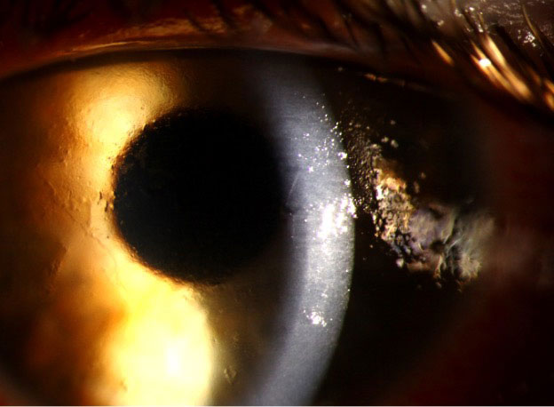 This young contact lens wearer presented with significant eye pain and had diffuse corneal epithelial irregularity. There was no infiltrate or anterior chamber reaction. Due to clinical suspicion for Acanthamoeba, she was monitored closely. At her two-day follow-up, early perineuritis was visible and the patient was treated with antiamoebic therapy. Her symptoms resolved quickly.