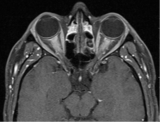 Fig. 4. This male in his mid-30s presented with severe eye pain bilaterally that was worse on eye movement. A CT scan was completed during the initial visit due to suspected myositis but was unremarkable. The patient returned to the emergency department three days later with a sudden and drastic decline in his visual acuity from 20/15 in each eye at the initial visit to no light perception in the right eye and 20/400 in the left eye. An MRI obtained that day (seen here) revealed bilateral ON. Labs eventually returned with elevated anti-MOG antibody titers.