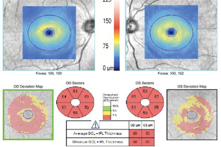 OCT of the optic nerve demonstrates mild retinal nerve fiber layer (RNFL) loss OD>OS and ganglion cell loss (GCL) loss OU.