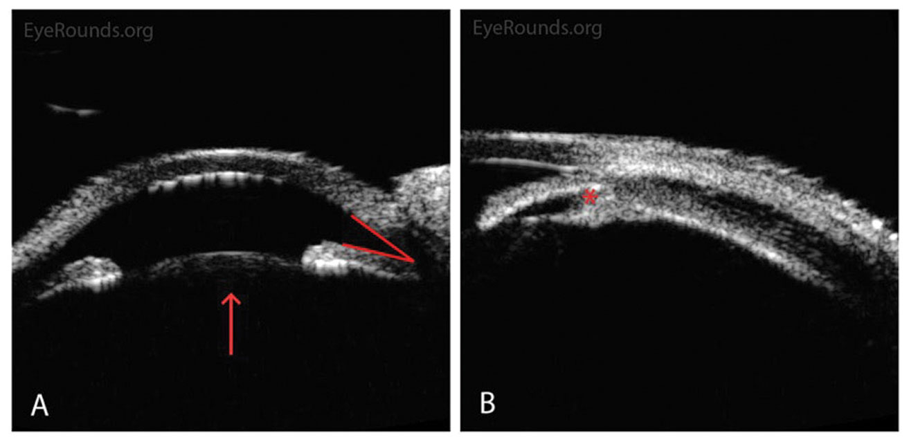 Anterior segment ultrasound shows a shallow anterior chamber, narrow angle, forward-displaced lens and anteriorly rotated ciliary body.