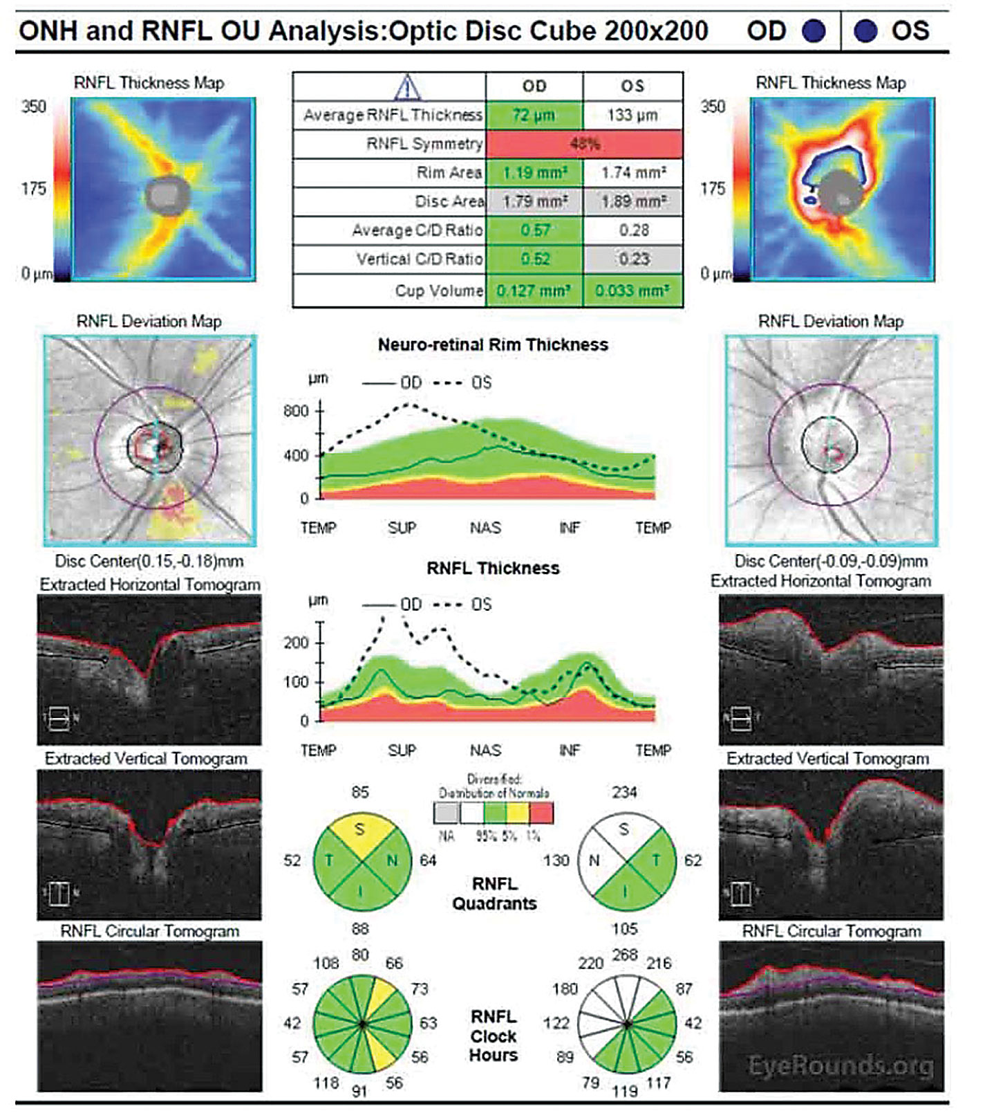 OCT of the optic nerve shows significantly increased RNFL and neuroretinal rim thickness in the superior and nasal rims OS.