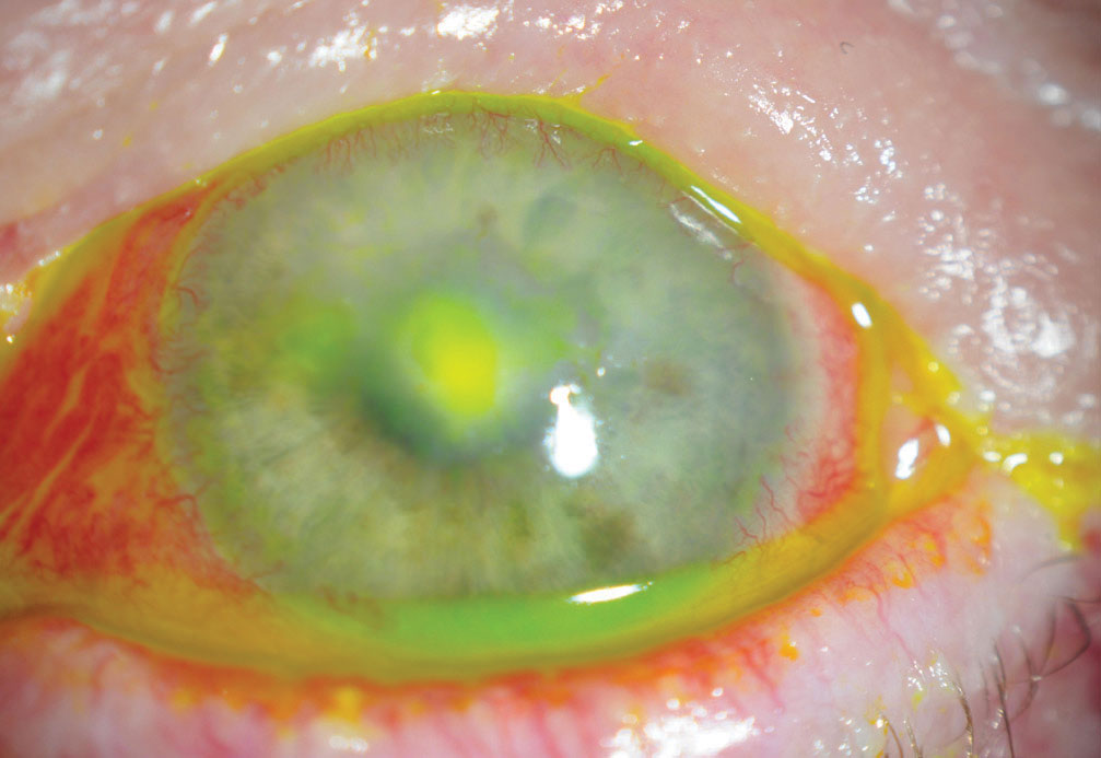 This neurotrophic cornea developed a bacterial ulcer. The patient came in acutely due to redness but was not in any pain.