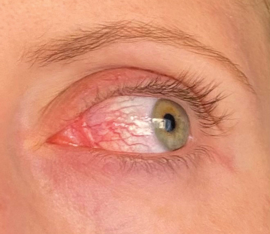 Sectoral episcleritis from a different angle in the same patient in the previous photo.