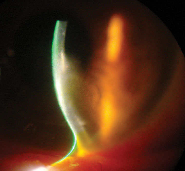 Fig. 2. Corneal thinning and opacity in the same patient as Figure 1.