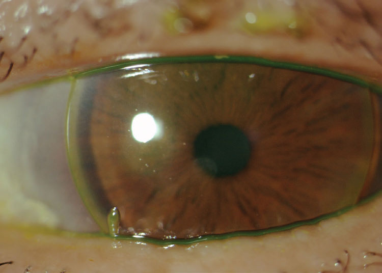 Fig. 3. Patient with history of presumed microbial keratitis from continuous wear of spherical GP lenses showing an anterior stromal scar near the pupil.