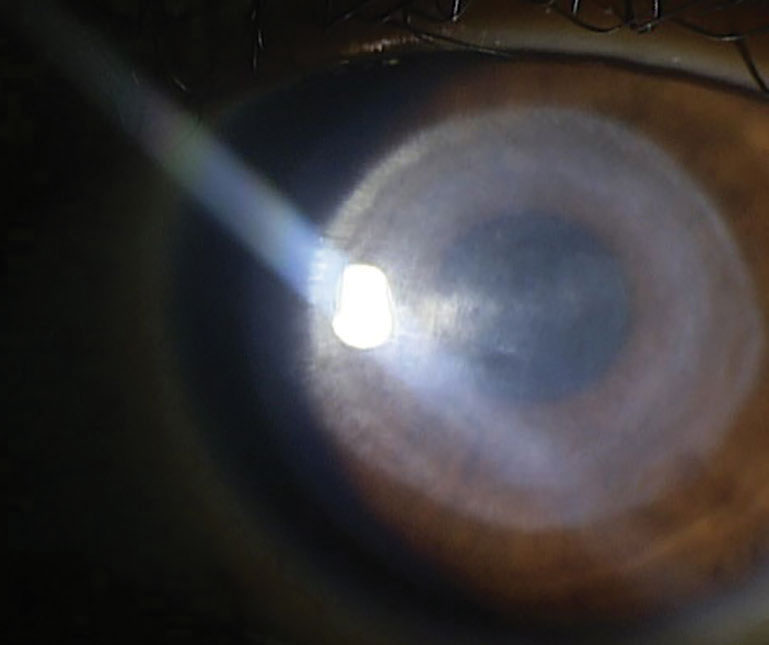 Fig. 5. Central corneal scarring remaining after presumed Pseudomonas ulcer from extended wear of soft contact lens.