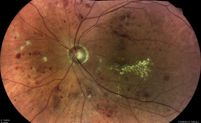 Severe nonproliferative diabetic retinopathy captured with the DRSplus (iCare).