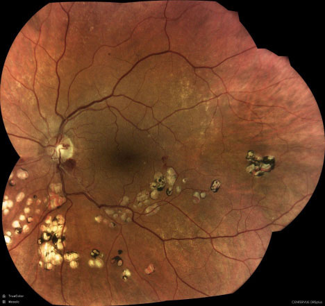 Inferior retinal vein occlusion seen with the DRSplus (iCare).