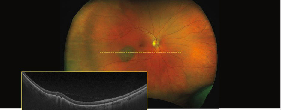 UWF pseudocolor Optos image with corresponding OCT scan showing a slightly elevated choroidal nevus with overlying drusen within the inferior temporal arcades of the right eye.