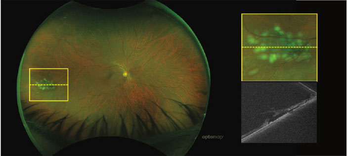 UWF pseudocolor Optos image with corresponding OCT scan showing a far peripheral tear temporally. There is a visible break in the neurosensory retina with subretinal fluid within the lesion.