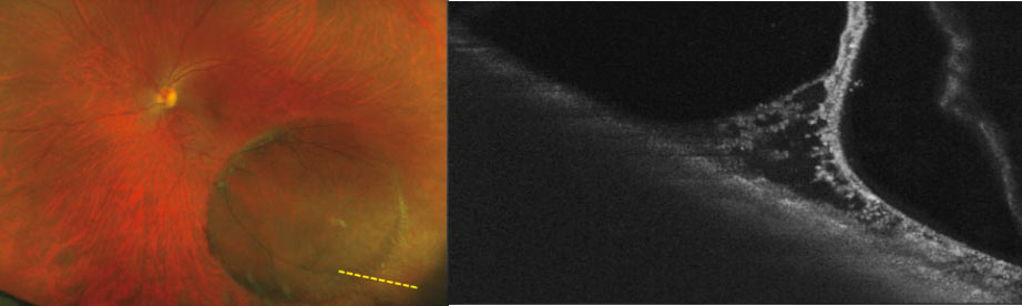 Inferotemporally located retinoschisis with corresponding OCT scan in the left eye. OCT displays the schitic cavity separating the inner retinal layer from the outer retinal layers.