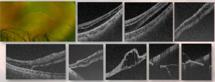 UWF pseudocolor Optos photography with corresponding OCT scan showing a chronic peripheral RD. OCT illustrates the separation between the neurosensory retina and underlying RPE. Serial OCT scans allow for full visualization of the lesion.