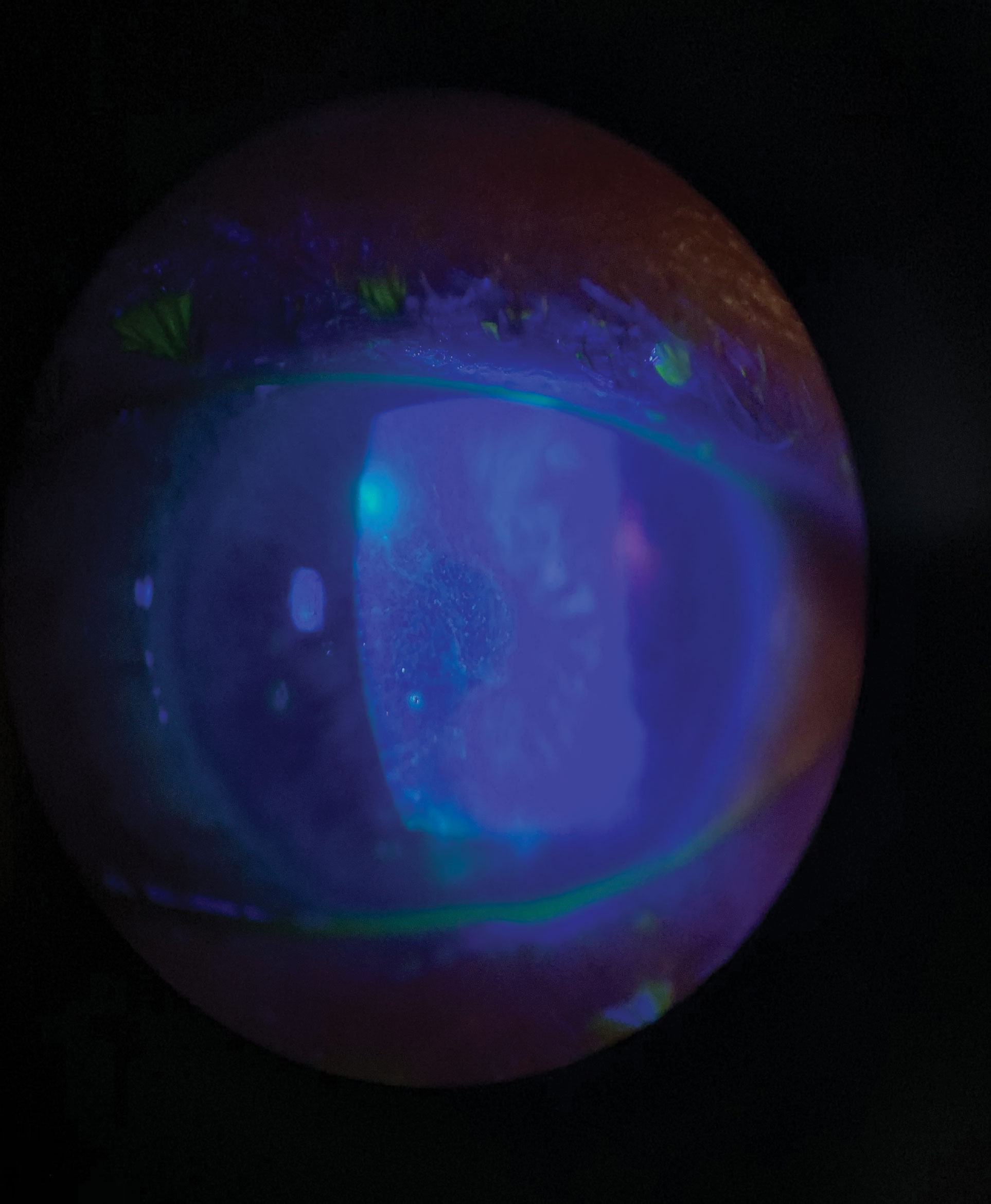 A resolving central dendrite with multifocal stromal keratitis with ulceration in a patient with an aggressive form of ocular HSVK who is recovering from COVID-19.