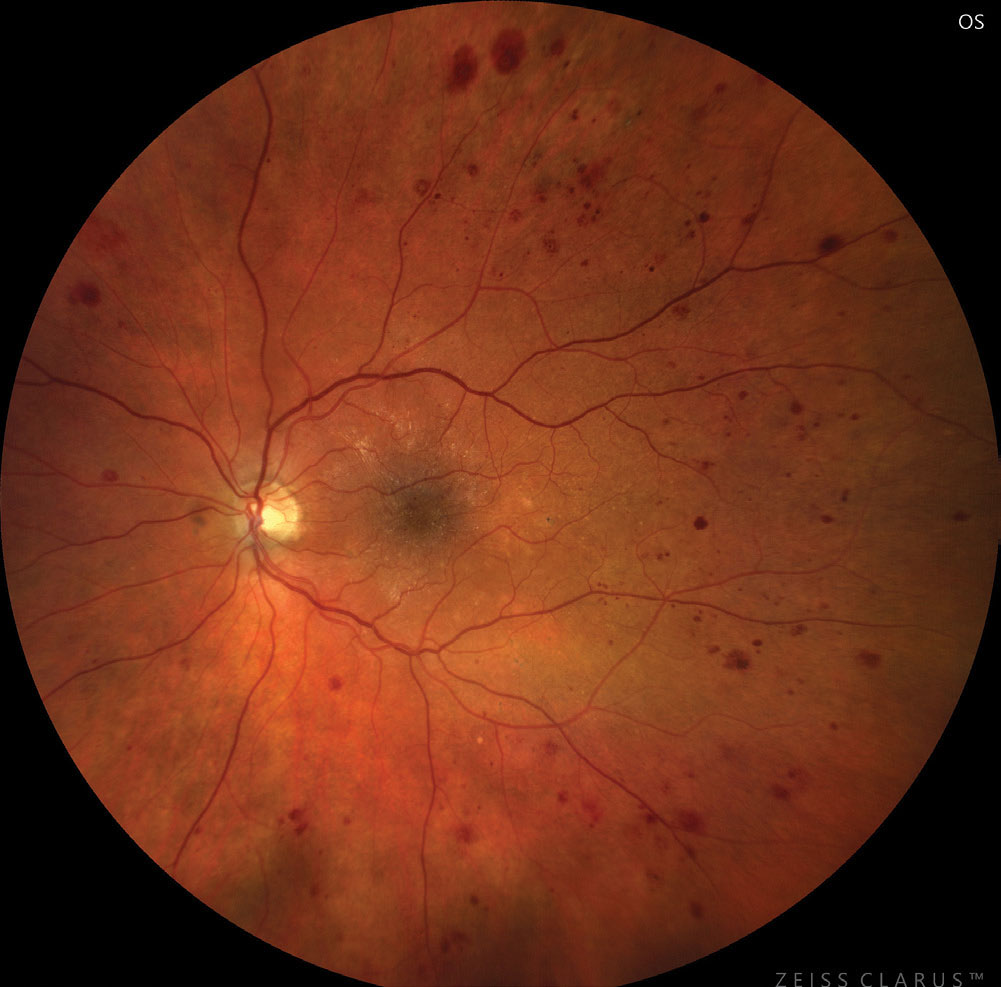 Severe NPDR based on hemorrhages and microaneurysms in four retinal quadrants.