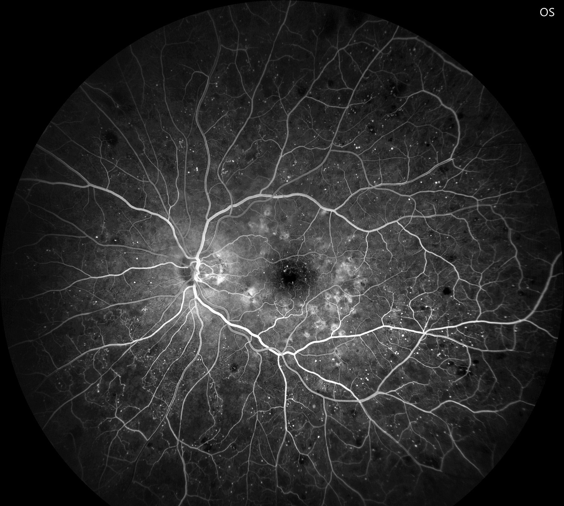Fluorescein angiography confirms early PDR with significant non-perfusion and neovascularization of the disc.